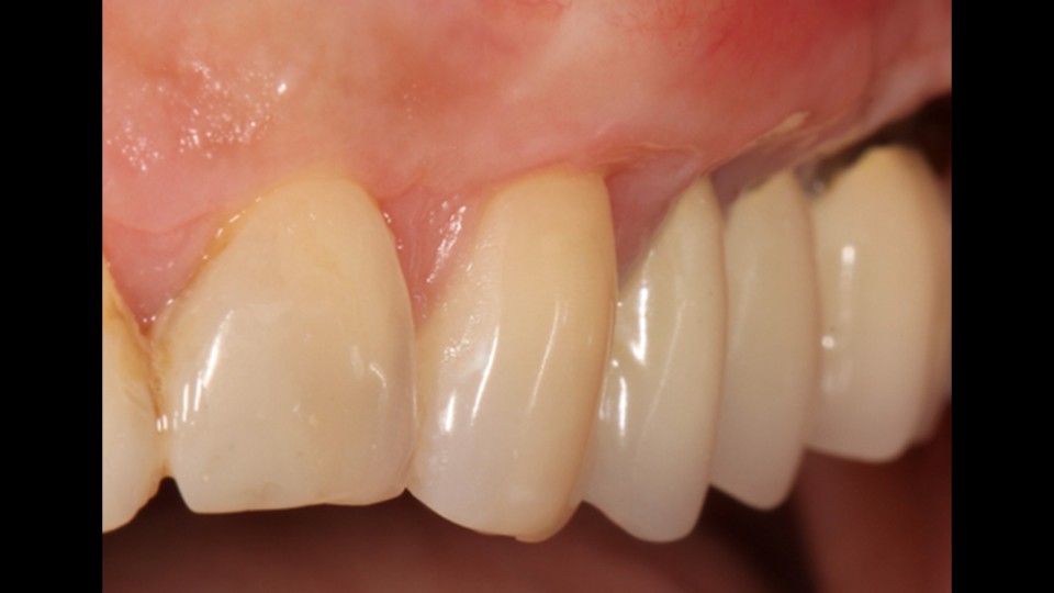 Greffes de gencive Chirurgie implantaire Dr Davarpanah